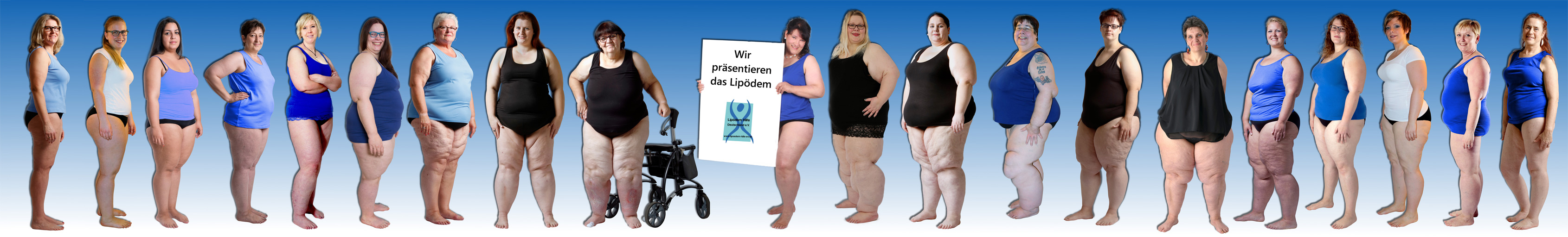 Das Lipödem hat viele Facetten