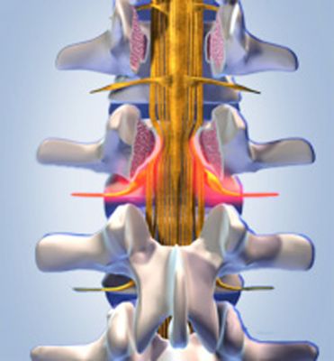apex spine spinalkanalstenose - Mit zunehmendem Alter leiden viele an einem verengten Spinalkanal